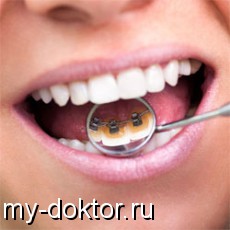 Ортопедичне лікування зубів лінгвальними брекетами