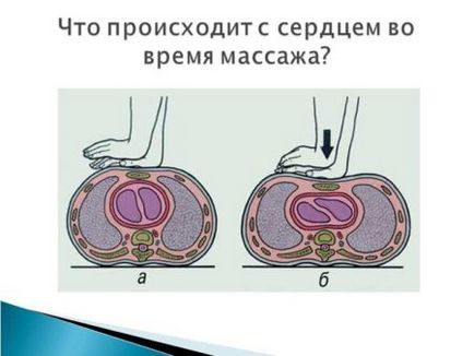 сърдечен арест