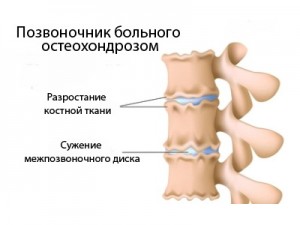 Osteochondroză patogeneză, etiologie, complicații neurologice