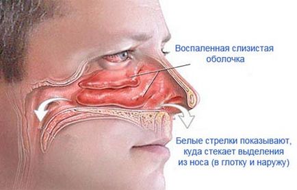 Îngrijorat - nasul curge! Metode de tratament, video