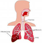 Pneumonie acută (pneumonie)