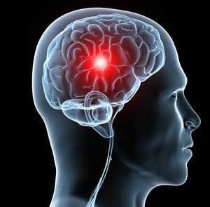 Tulburări acute ale circulației cerebrale, tipurile acesteia