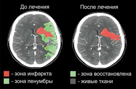 Пенумбра - «вікно порятунку» при інсульті