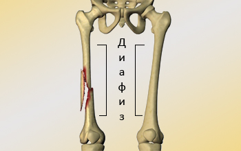 Fracturile diafizelor femurului 2