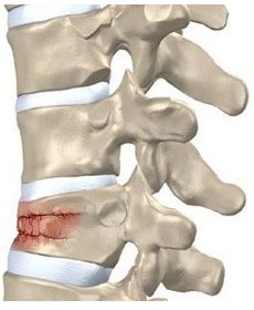 Fracturile simptomelor coloanei vertebrale, primul ajutor și metodele moderne de tratament