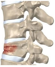 Törések a gerinc tünetek, elsősegély, és a modern kezelési módszerek