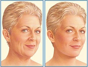 A plasztikai sebészet az arcon jellemzői a végtelen emelő körkörös és endoszkópos műanyagok