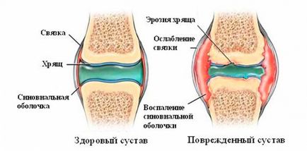 Чому хрустять суглоби у всьому тілі, причини хрускоту в суглобах