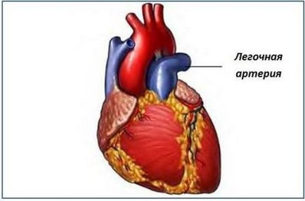 Defectele valvei pulmonare, mc intercardio