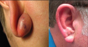 După o perforare a urechii, sa format o bucată, de ce se formează și ce să facă