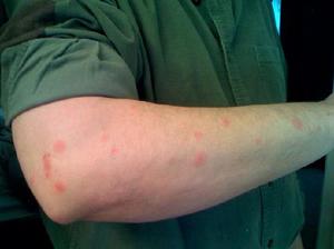 Bedbugs moduri și cauze de aspectul lor în apartament, indiferent dacă mușcăturile lor sunt periculoase, de prevenire