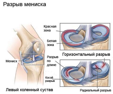 Пошкодження менісків колінного суглоба