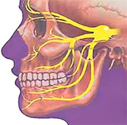 Leziuni nervoase în timpul implantării