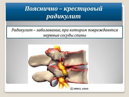 Попереково - крижовий радикуліт - презентація 207080-31