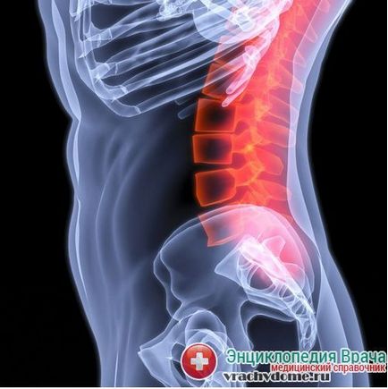 Protruzia discului intervertebral al coloanei vertebrale cervicale, lombare