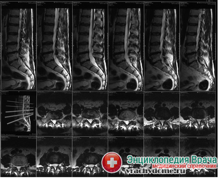 Protruzia discului intervertebral al coloanei vertebrale cervicale, lombare