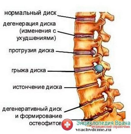 Protruzia discului intervertebral al coloanei vertebrale cervicale, lombare