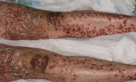 Psoriasis és a dohányzás, ez érinti a betegség - útmutató a bőrbetegségek