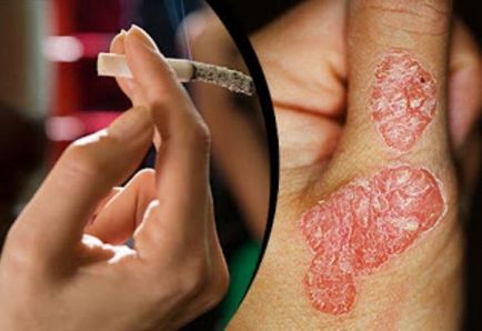 Psoriasis és a dohányzás, ez érinti a betegség - útmutató a bőrbetegségek