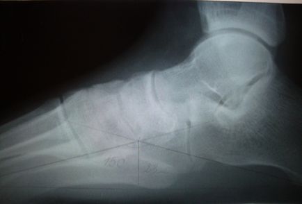 X-ray de picior cu încărcătură