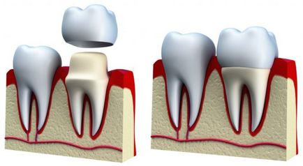 Реставрація зубів фото до і після відновлення, види і методи