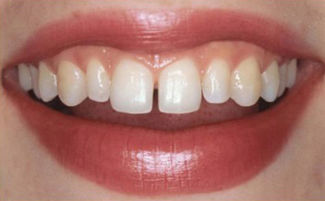 Restaurarea dinților înainte și după restaurare, tipuri și metode