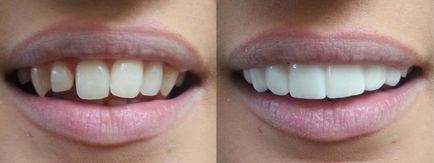 Реставрація зубів фото до і після відновлення, види і методи