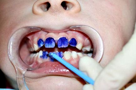 Argintarea dinților copilului