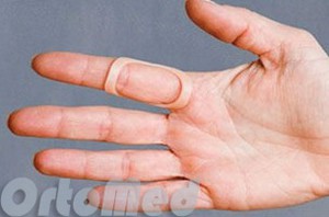 Trigger ujját (szűkületet lingamentit), műtét, patent ujj közös