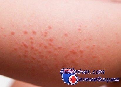 Симптоми, ознаки і причини виникнення алергії у дітей
