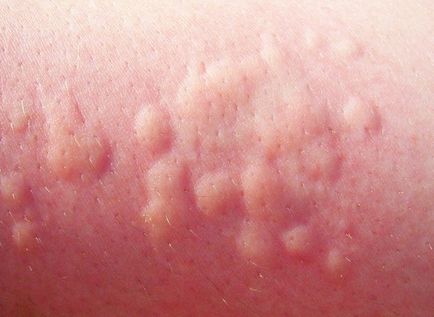 Симптоми, ознаки і причини виникнення алергії у дітей