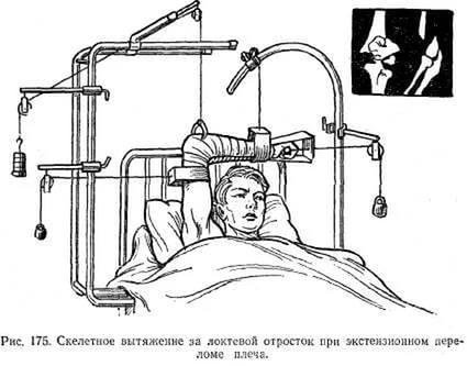 O tractare scheletică în caz de fractură