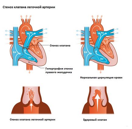 Стеноз клапана легеневої артерії - причини звуження легеневого клапана, фактори ризику, симптоми