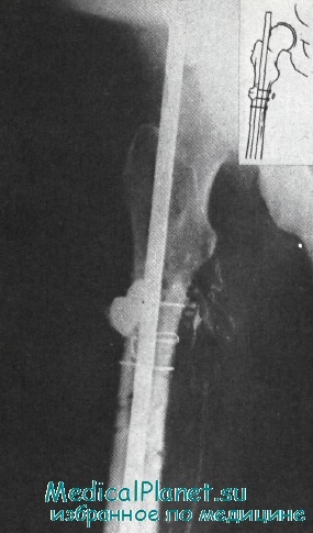 Tactica tratamentului fistulei după osteosinteza fracturilor