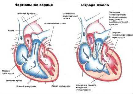 Тетрада фалло у дітей і новонароджених лікування, операція