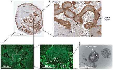 Chimioterapia cancerului de punct va fi comandată de nanorobot