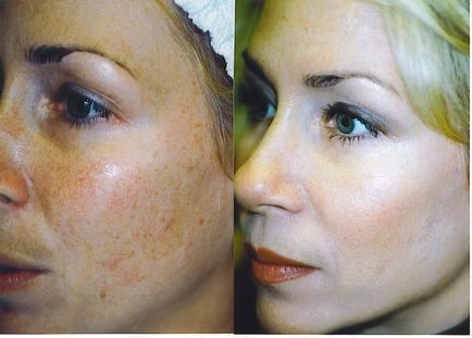 Ультразвукова чистка обличчя - фото до і після