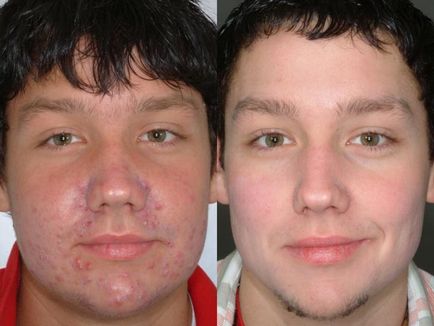 Curatarea feței cu ultrasunete - fotografii înainte și după