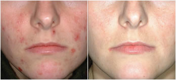 Ультразвукова чистка обличчя - фото до і після