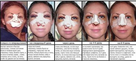Догляд за носом після ринопластики - процедури, масаж і препарати
