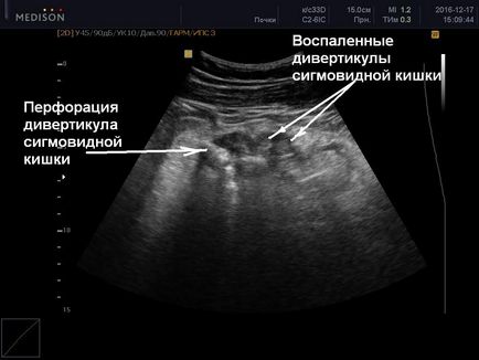 Uzi intestine