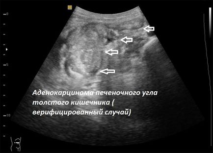 Uzi intestine