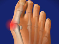 Valgus deformare a piciorului (hallux valgus) - cauze, tratament, funcționare