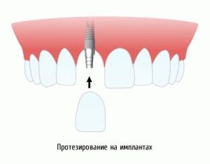 Варіанти протезування зубів