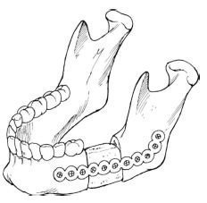 Variante de reconstrucție a maxilarului inferior