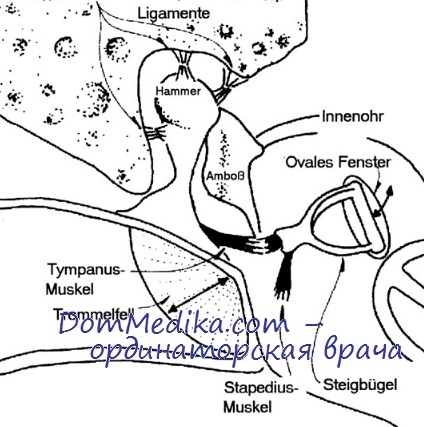 Variații ale stapedoplastiei pistoanelor stapedoplastice și stapedectomiei fiziologice