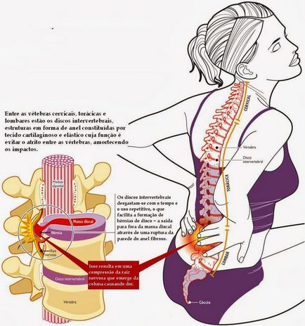 Important! Semnale periculoase ale herniei intervertebrale, întotdeauna în formă!