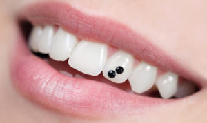 Furnizori - tipuri, etape de instalare, contraindicații - dinte medic
