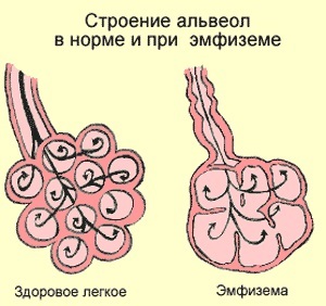 ХОЗЛ, емфізема, астма