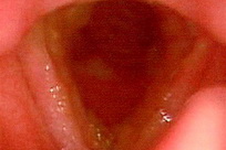 Infecții cronice inflamatorii ale laringelui - laringită cronică edematoasă-polipică, tratament în